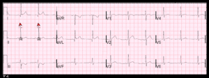 a Very Rare Cardiologic Condition